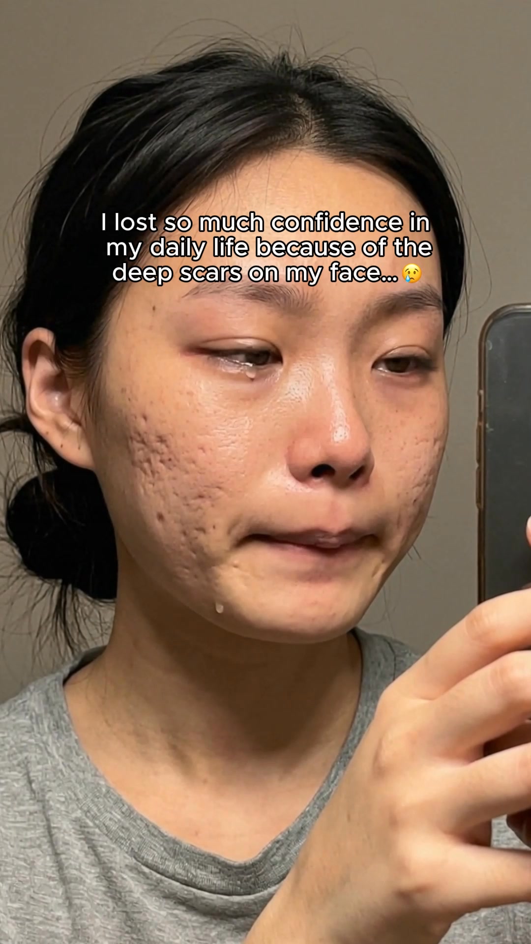 Salmon DNA Heals Acne Scars