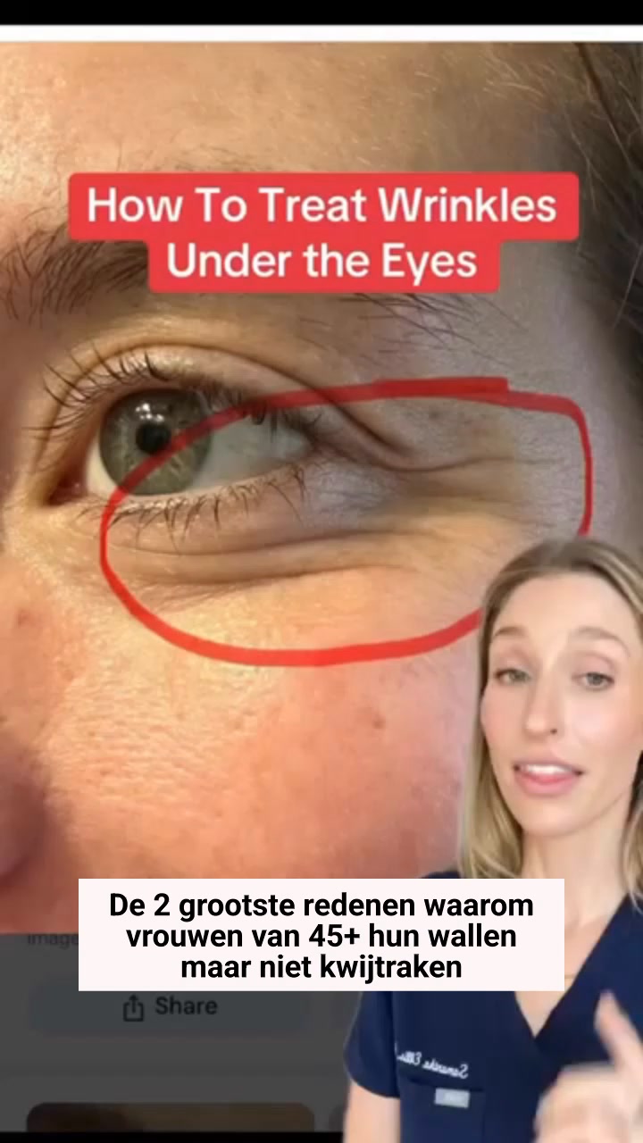 Dermatoloog: Doe DIT Voor Je Wallen >>
