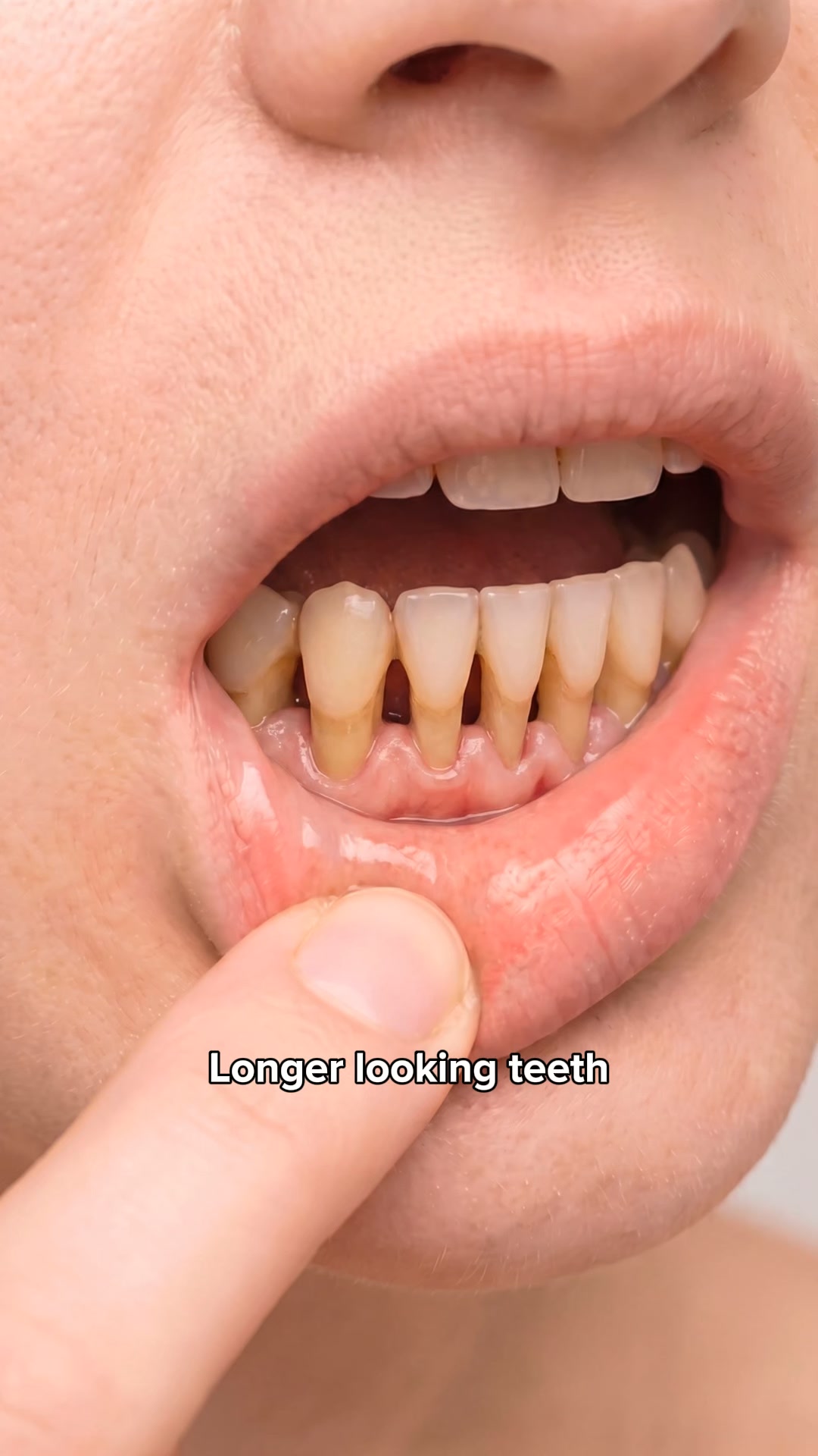 My Gums Kept Pulling Back
