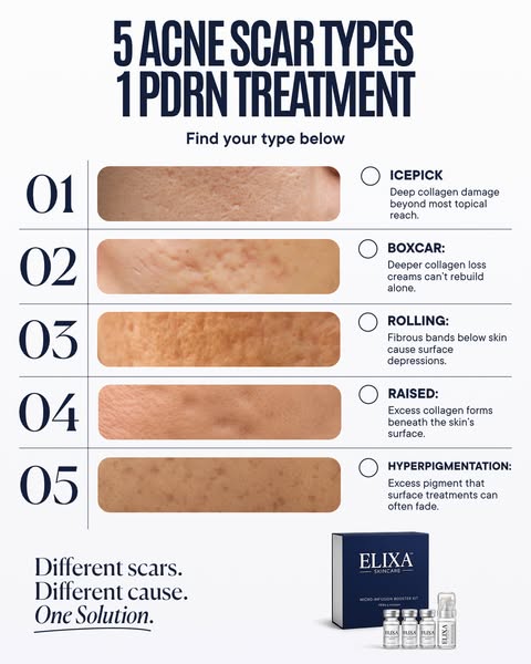 The Ultimate Acne Scar Solution