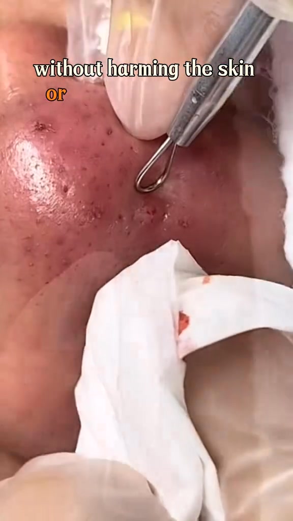 Blackhead Remover Tools