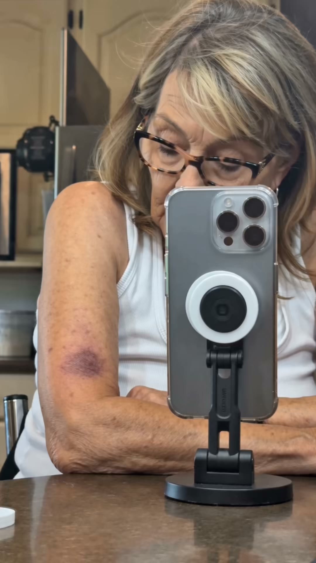 Bruises Gone In Days!