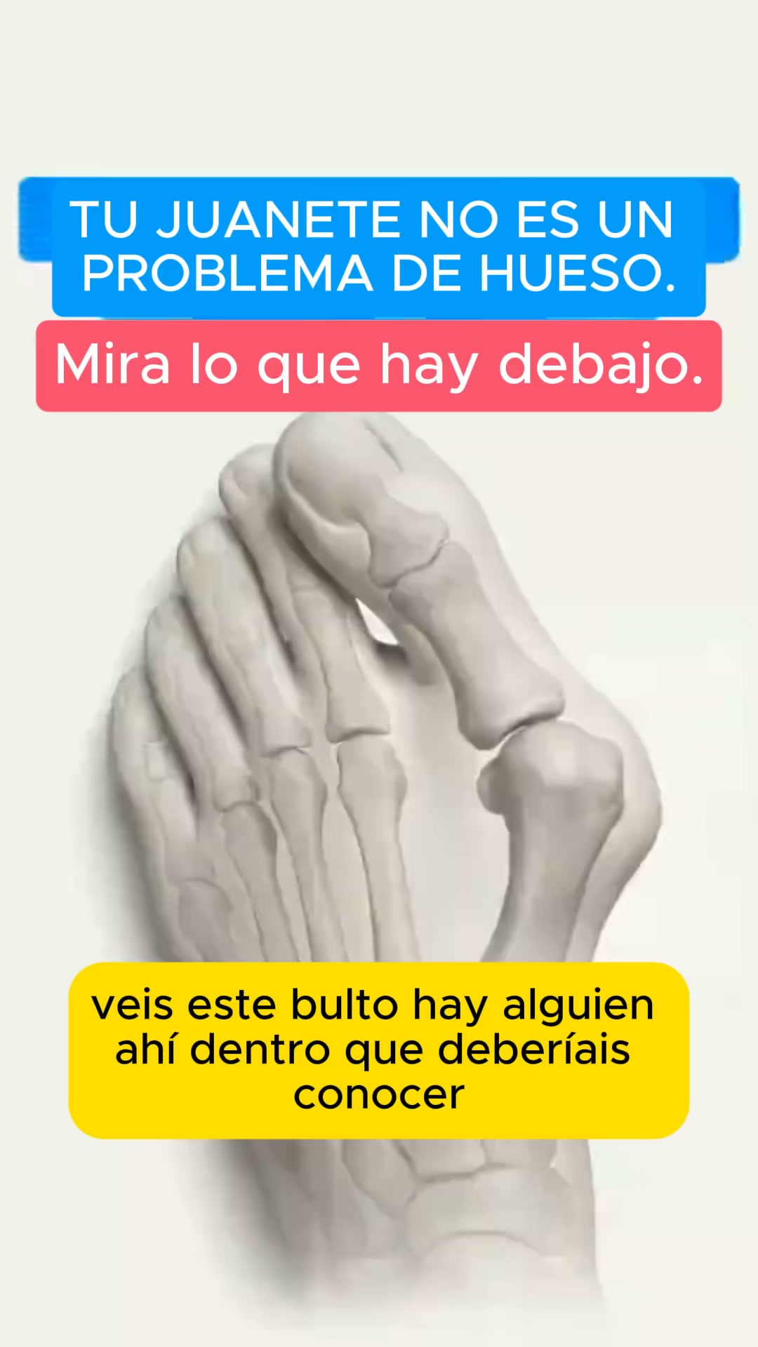 Evita el quirófano del juanete