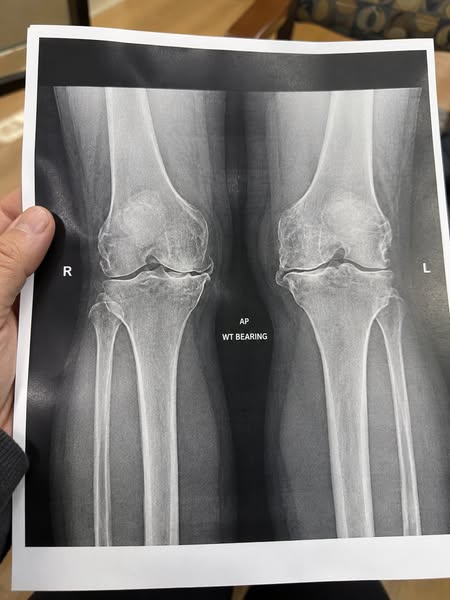 Stop Letting Knee Osteoarthritis Hold You Back