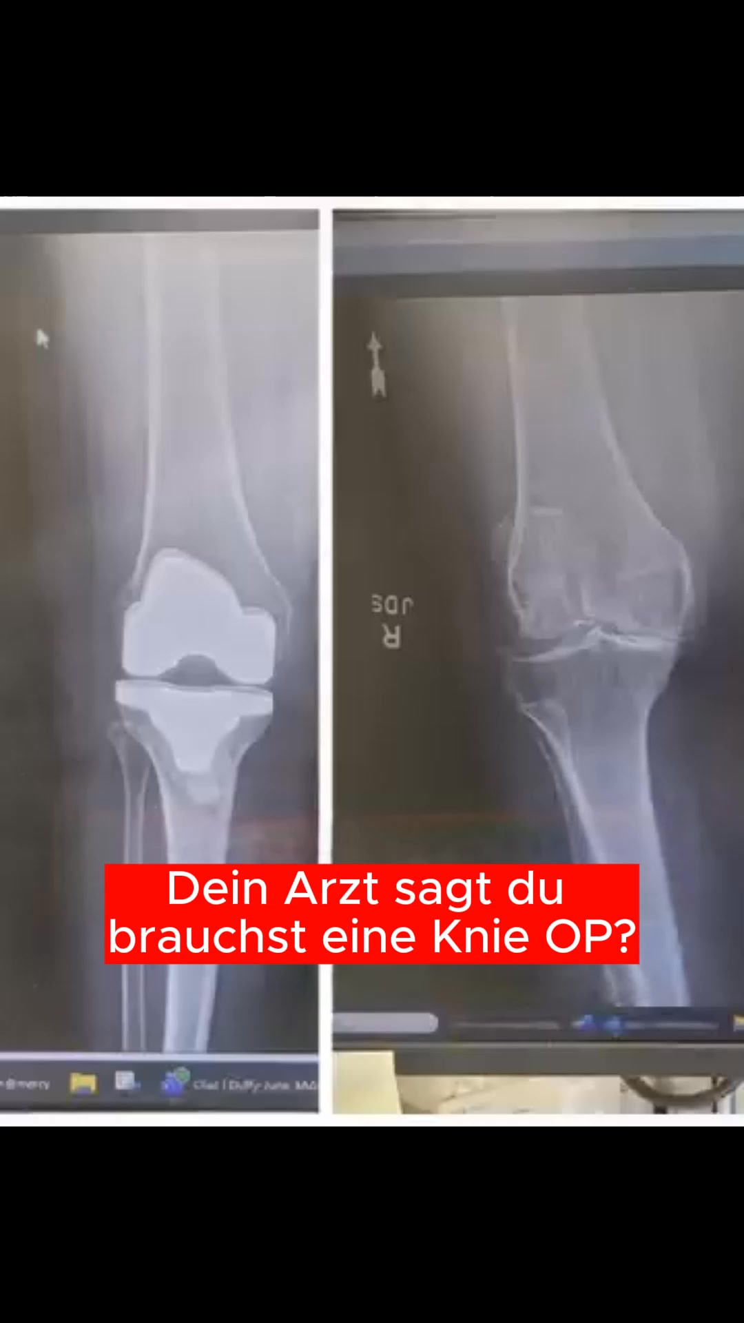 Die einfachste Entlastung bei Arthrose... so geht's