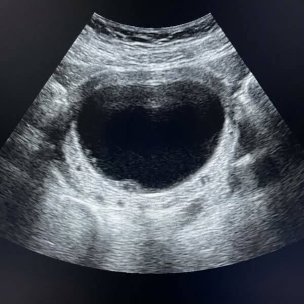 Why your overactive bladder is not a "muscle" problem, according to a urologist