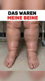 Schwellungen natürlich lindern
