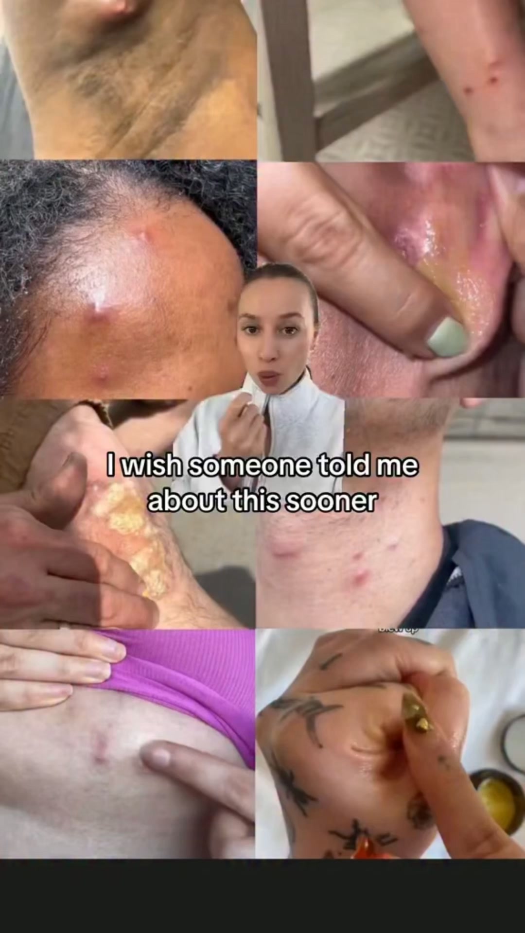 Different Skin-Fold Problems. One Simple Routine.