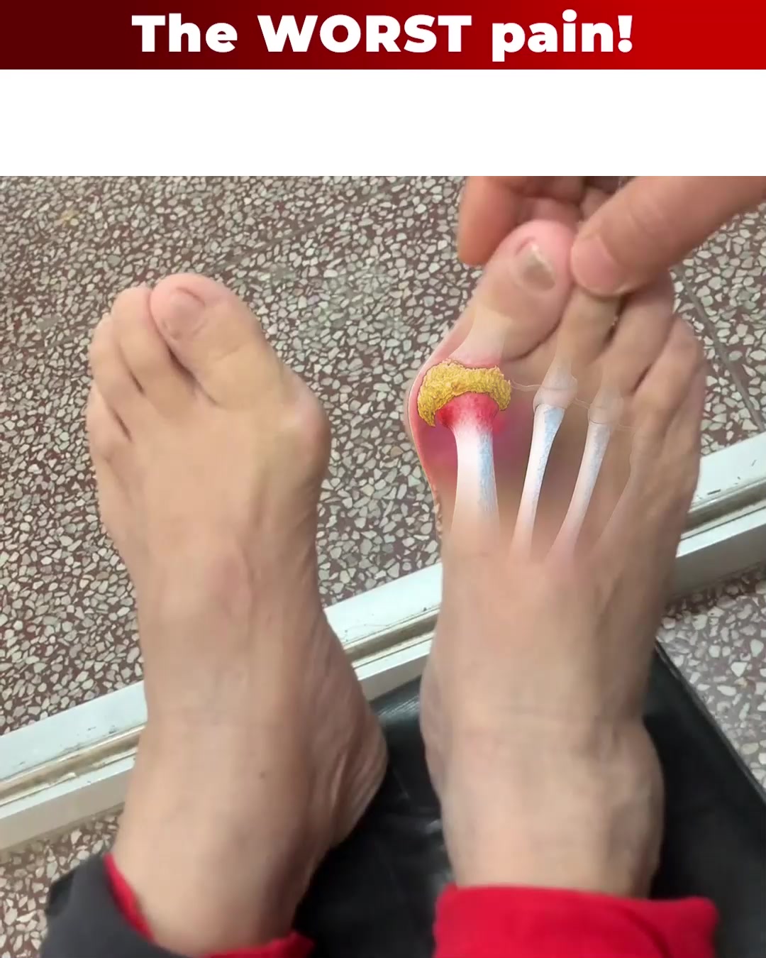 No More Bunion Discomfort!
