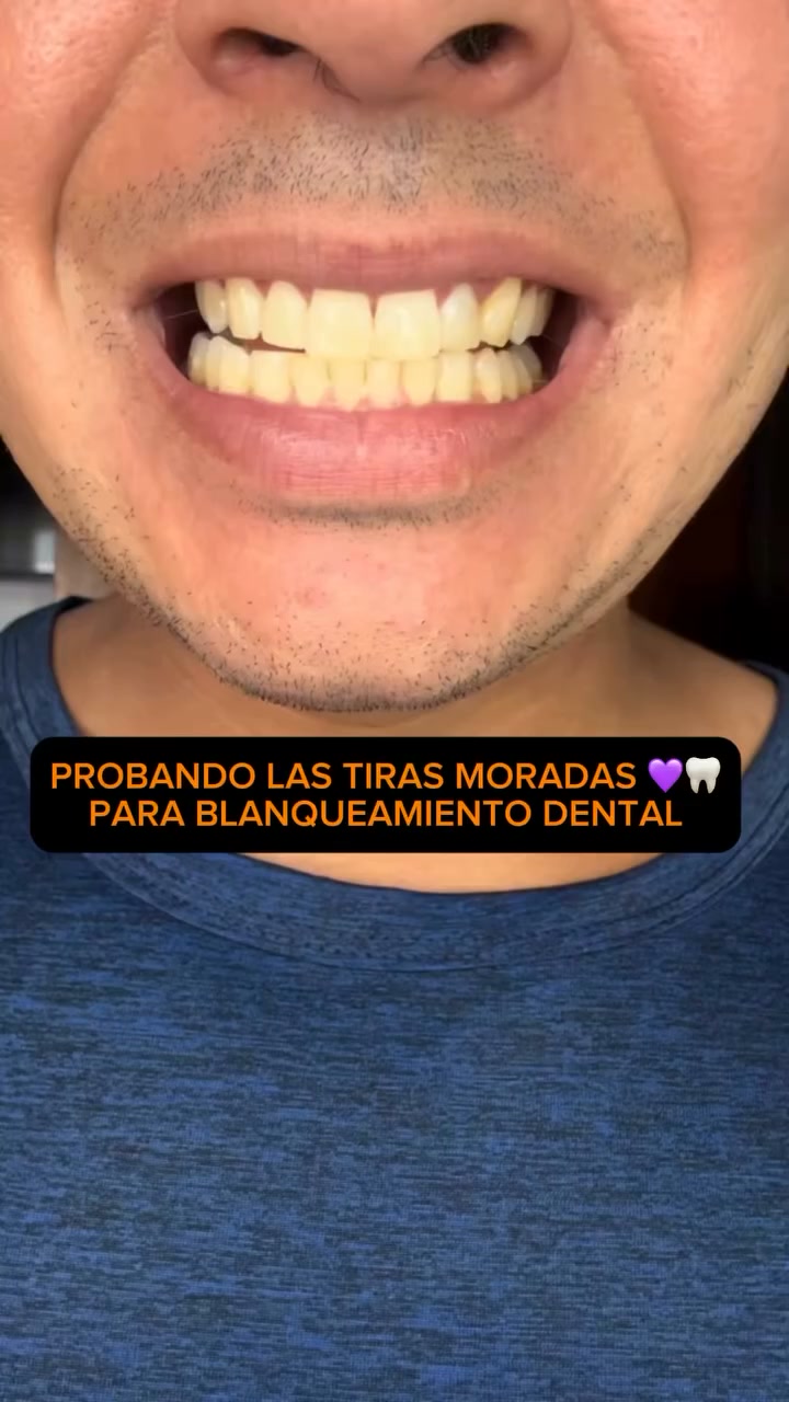 Así quedan los dientes después de las tiras V34