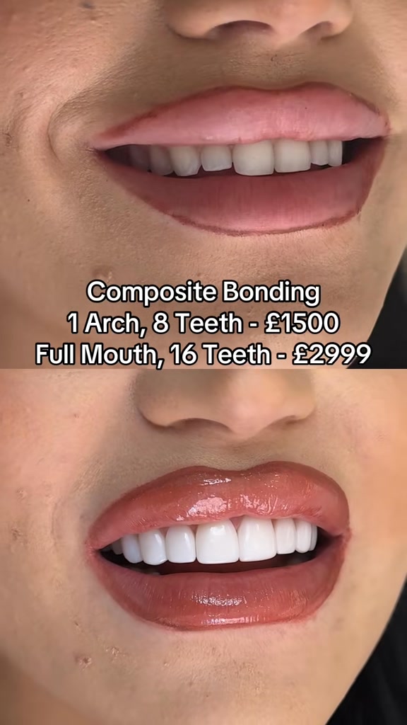 Up to 50% Composite Bonding and Veneers