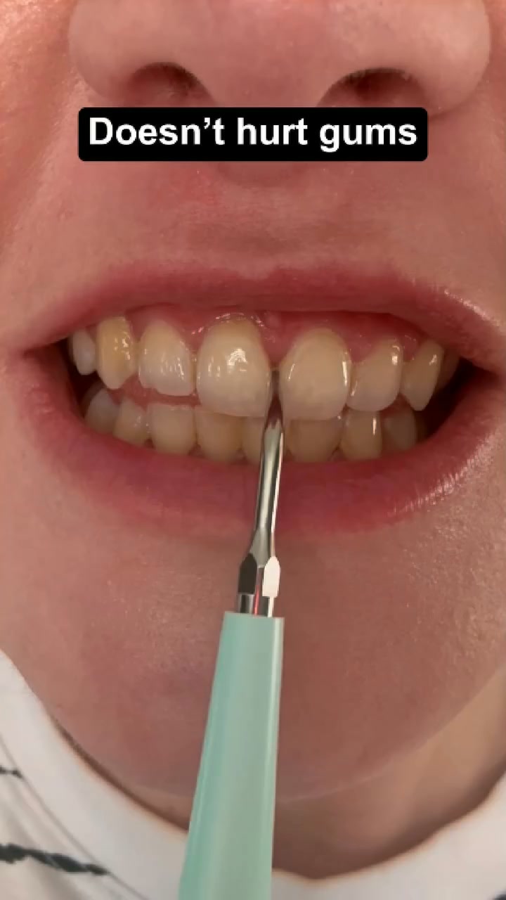 Remove Hardened Tartar Painlessly At Home