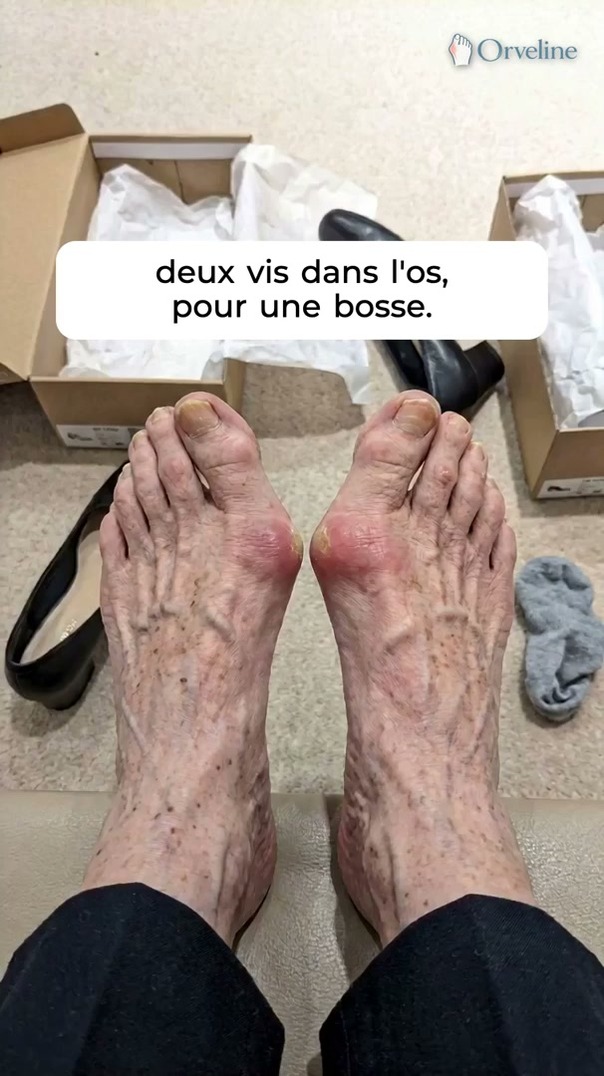 Avant le bistouri, le muscle · 60 jours