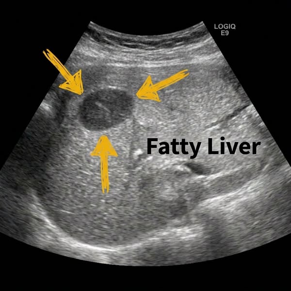 I Reversed My Fatty Liver In 9 weeks. And Milk Thistle Did Nothing.