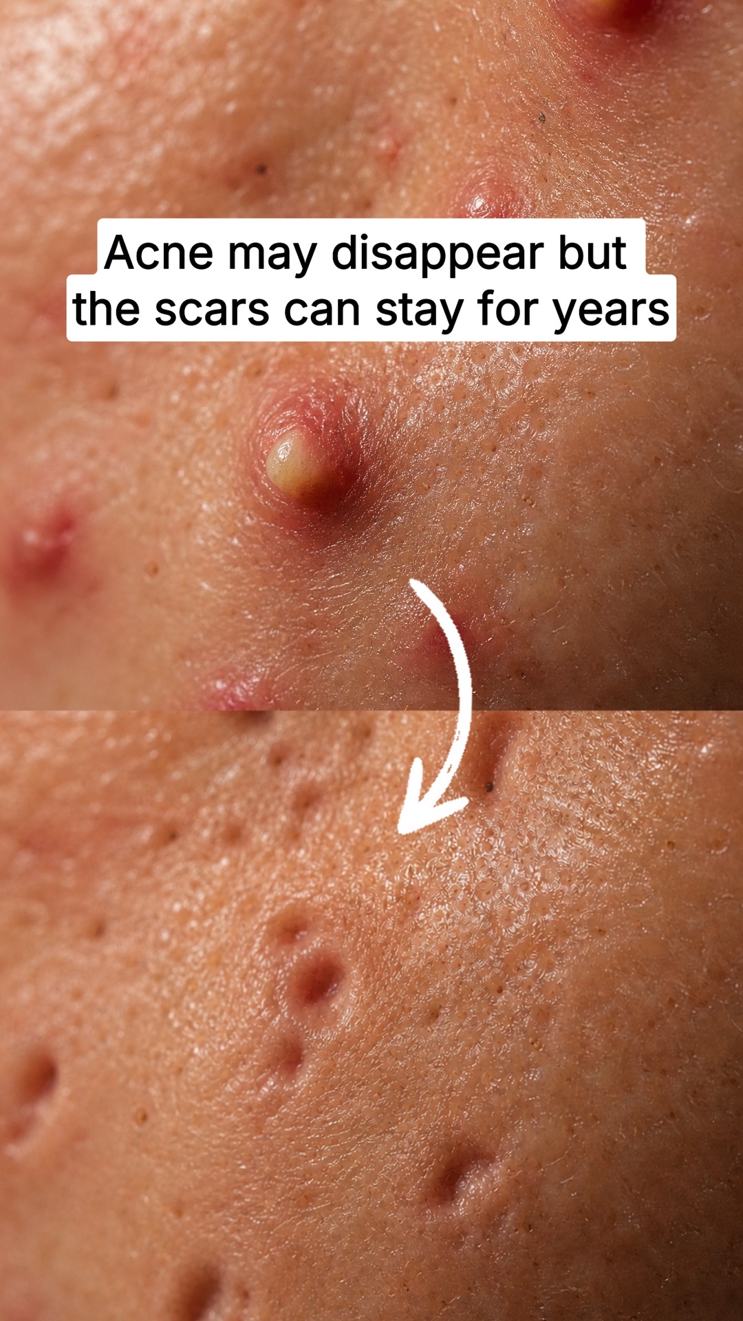 The Salmon DNA Hack Repair For Acne Scars