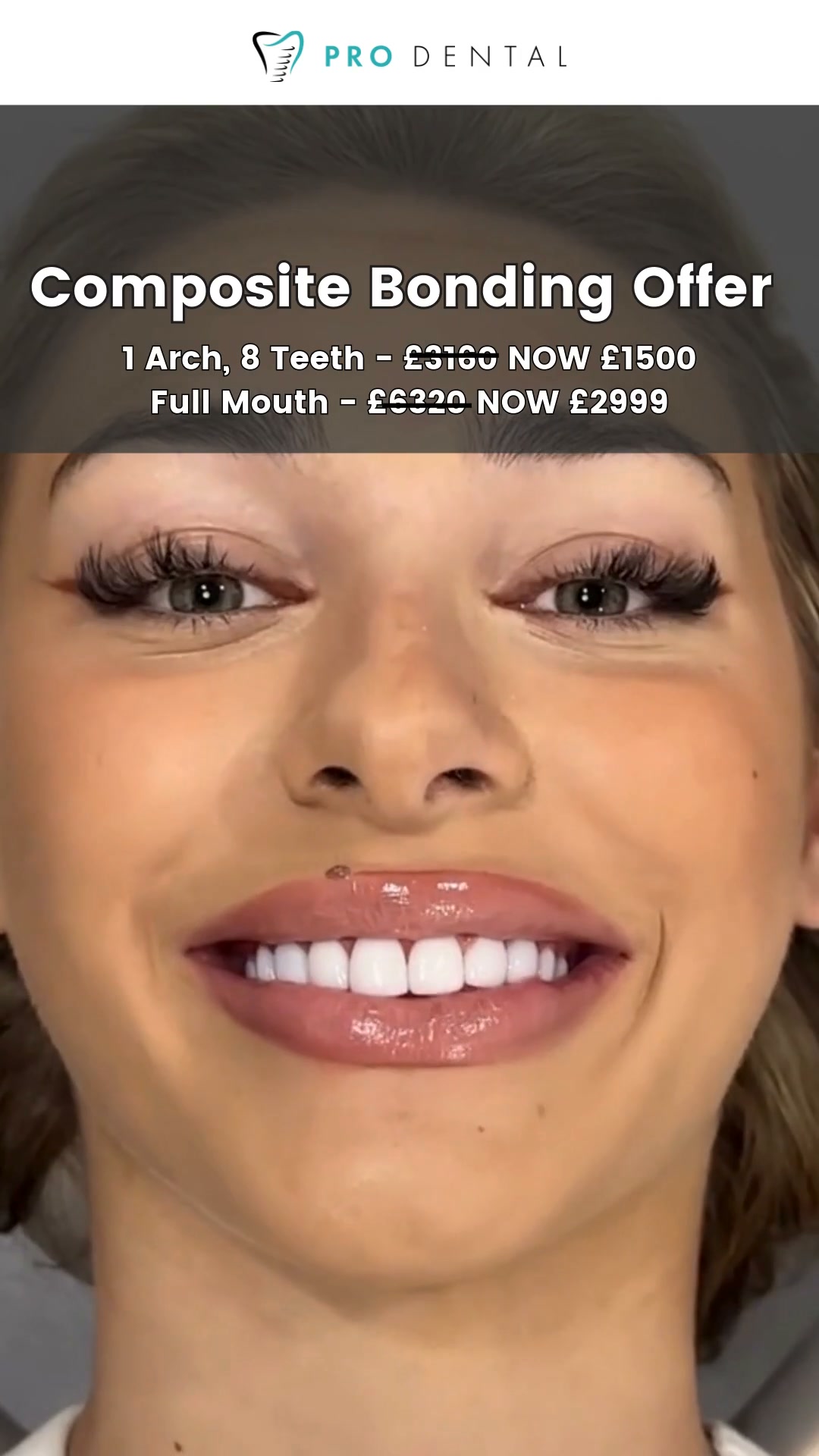 Up to 50% Composite Bonding and Veneers