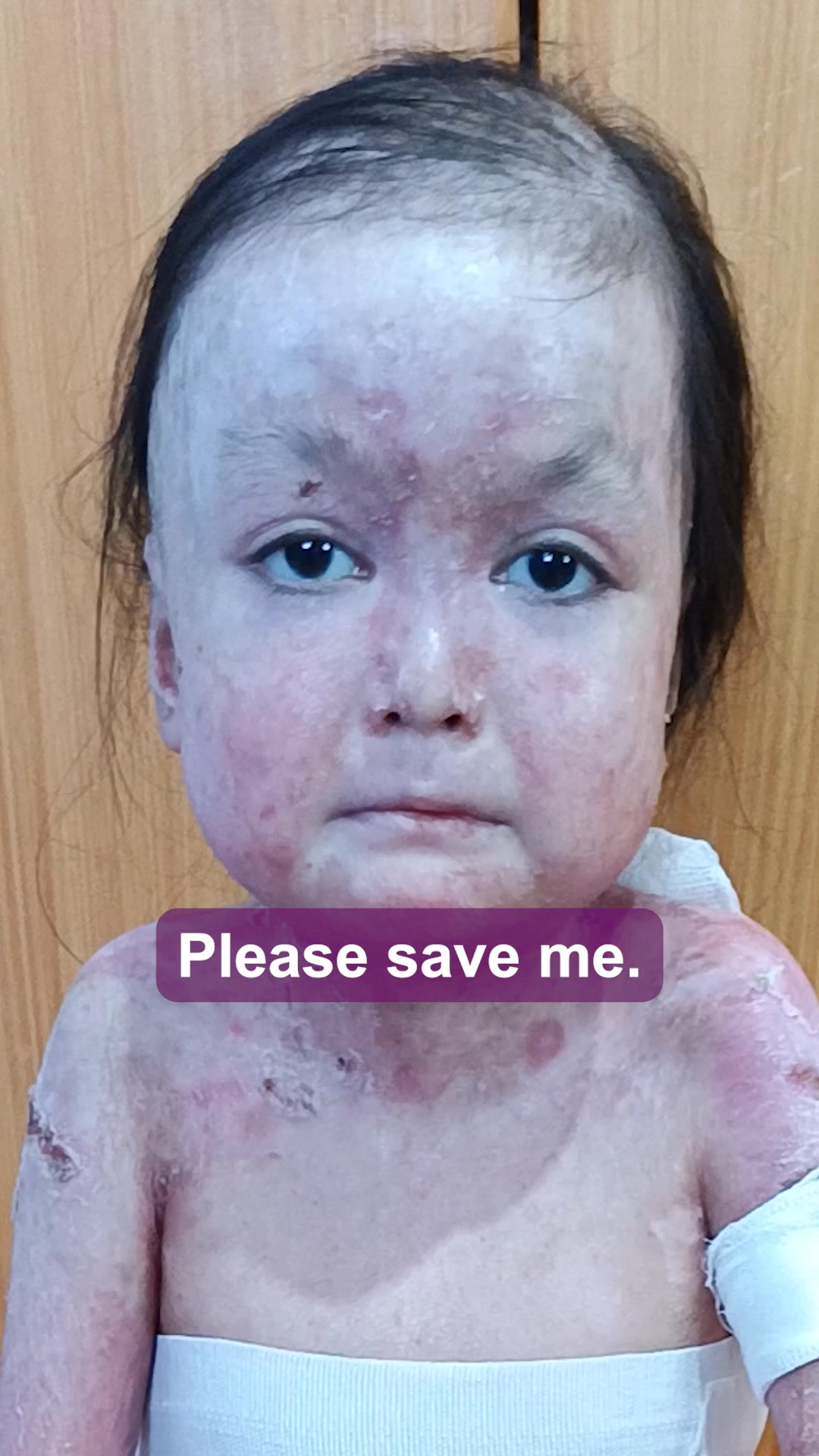 Shamila’s Skin Is Falling Off. Help Her.
