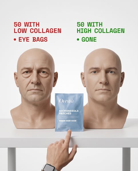 Low collagen = eye bags. Fix the collagen