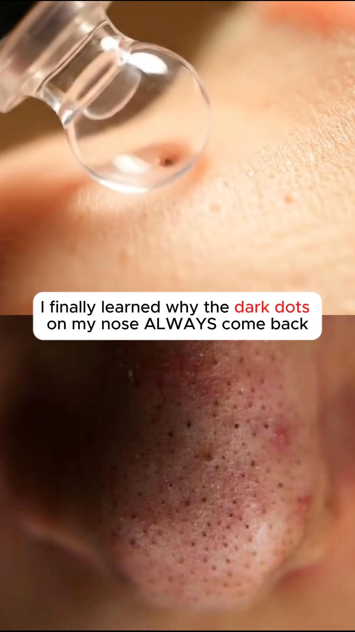 No More Nose Bumps