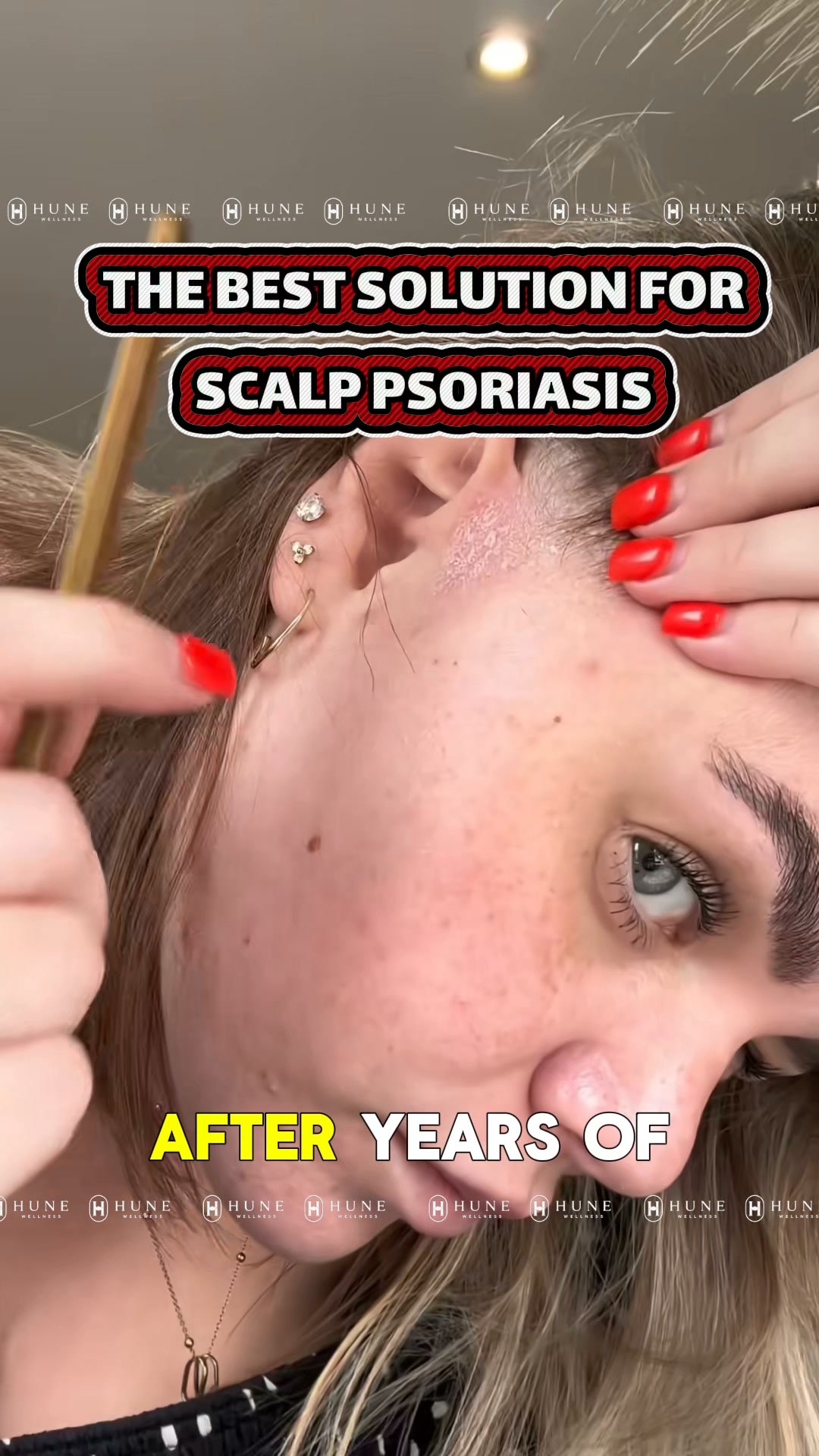 The Complete Steroid-Free Scalp Routine