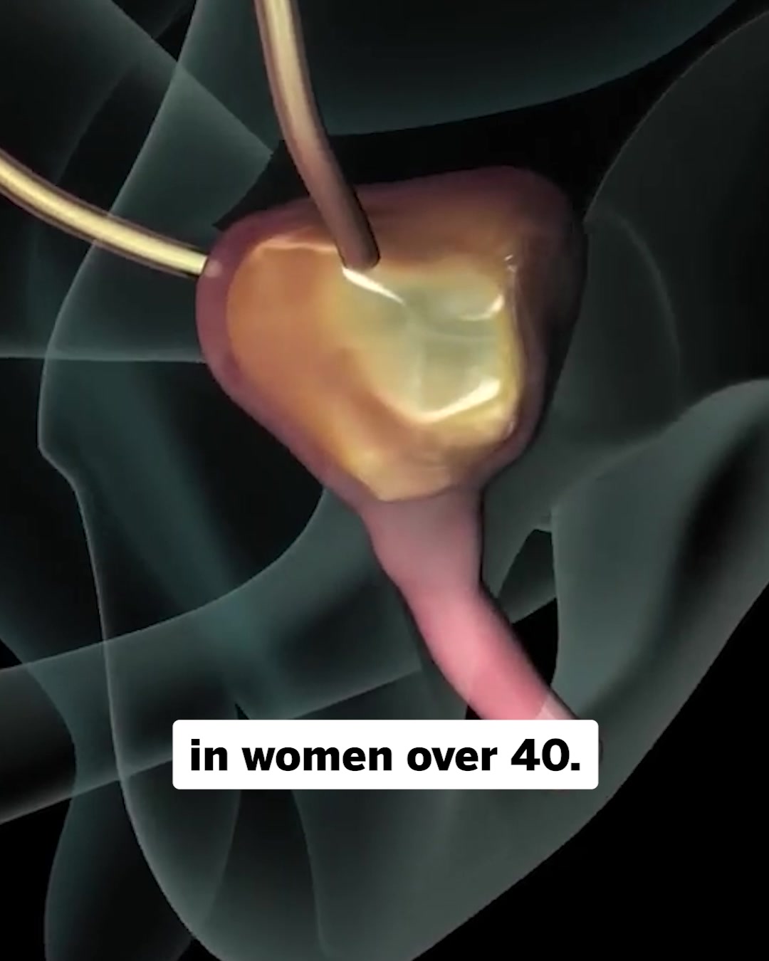 The Simple Fix for Bladder Leaks - Regain Control