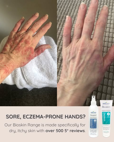Eczema on your hands making life harder?