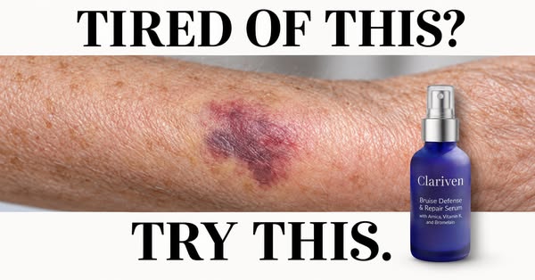 Bruise Gone In Days