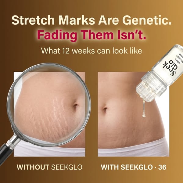 Stretch Marks? Try This At Home