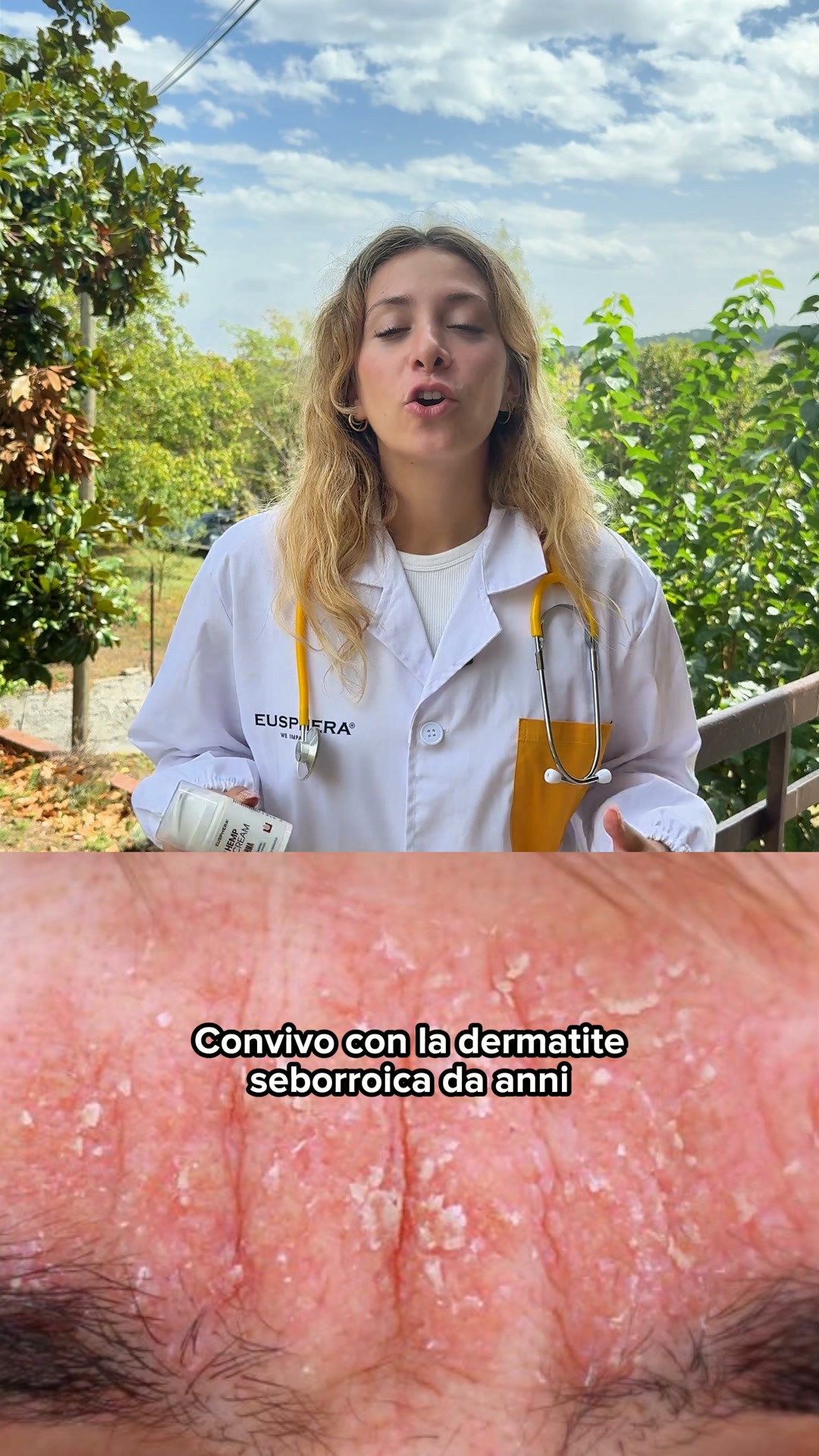 Supporto naturale per la tua Dermatite Seborroica