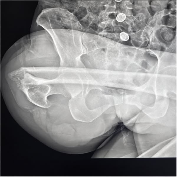 The Reason Your DEXA Numbers Won't Move