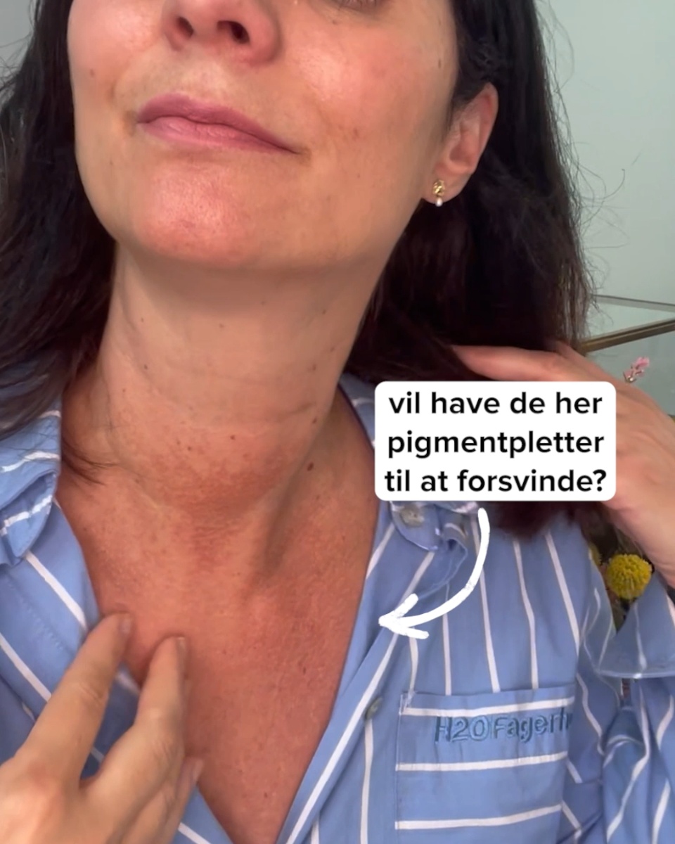 Gør pigmentpletter mindre synlige