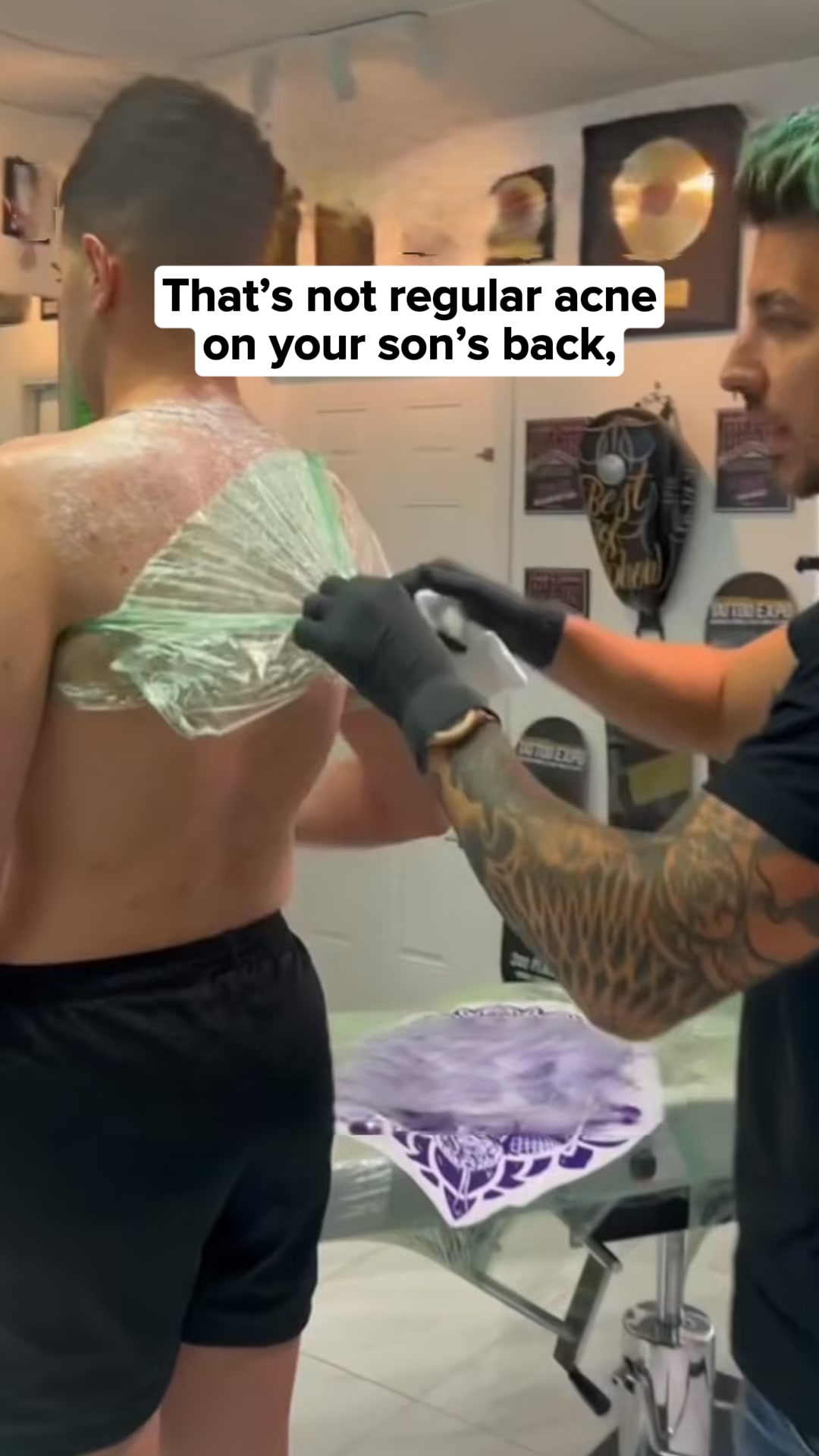 Designed for Back & Body Acne.