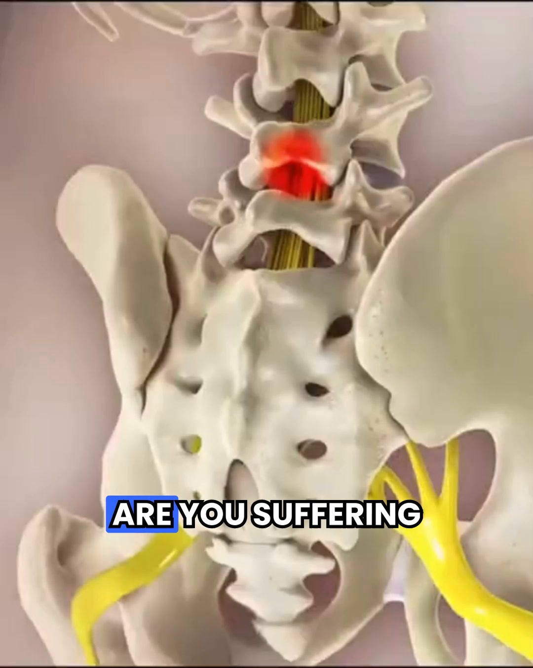 Relieve Sciatica & Lower Back Pain While You Sleep