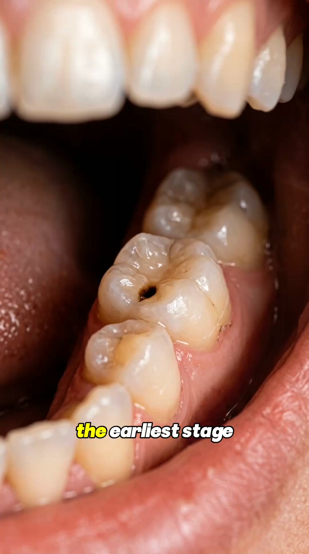 Whiter Teeth Now