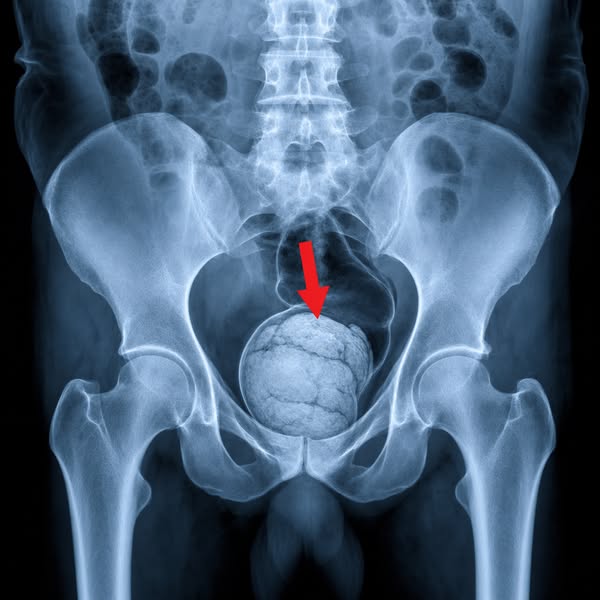 Read This Before Your Next Laxative