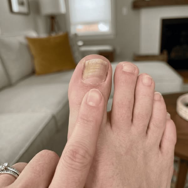 A mycologist told me why nothing works for toenail fungus
