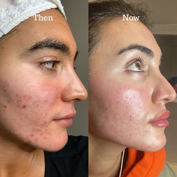 Book Your Acne Consultation