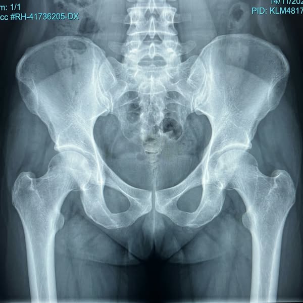 finally figured out my hip pain after 2 years