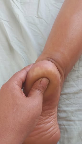 Kanske har du inte plantar fasciit