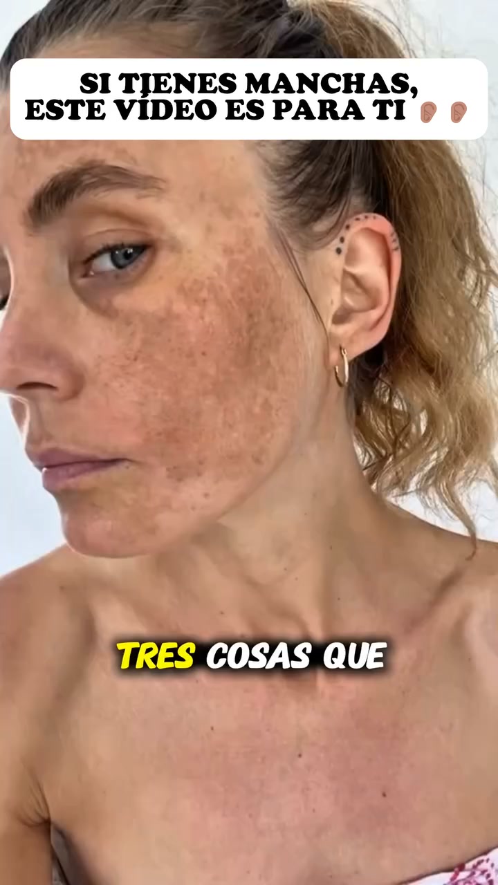 ¿Manchas en la piel? Acláralas con la Crema de Arbutina OFERTA 2 X 1