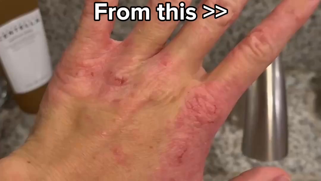 Redness & Itching GONE immediately