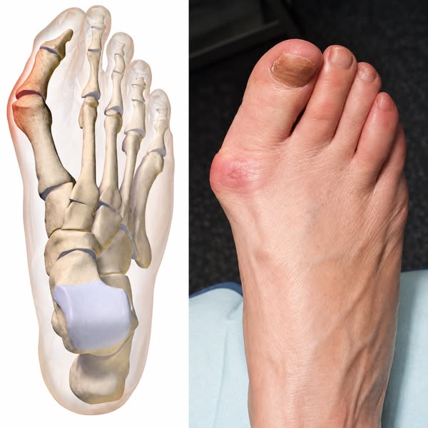 Read This If Your Shoes Hurt Your Bunions