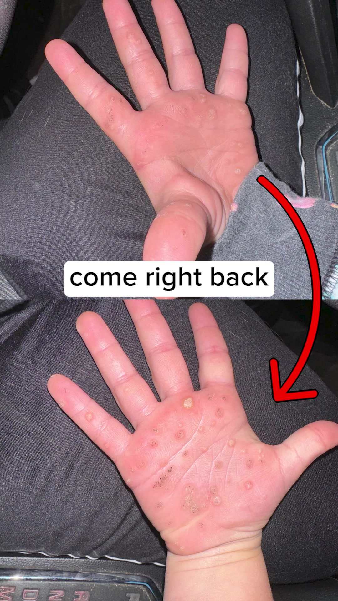 A Solution For Warts That Works