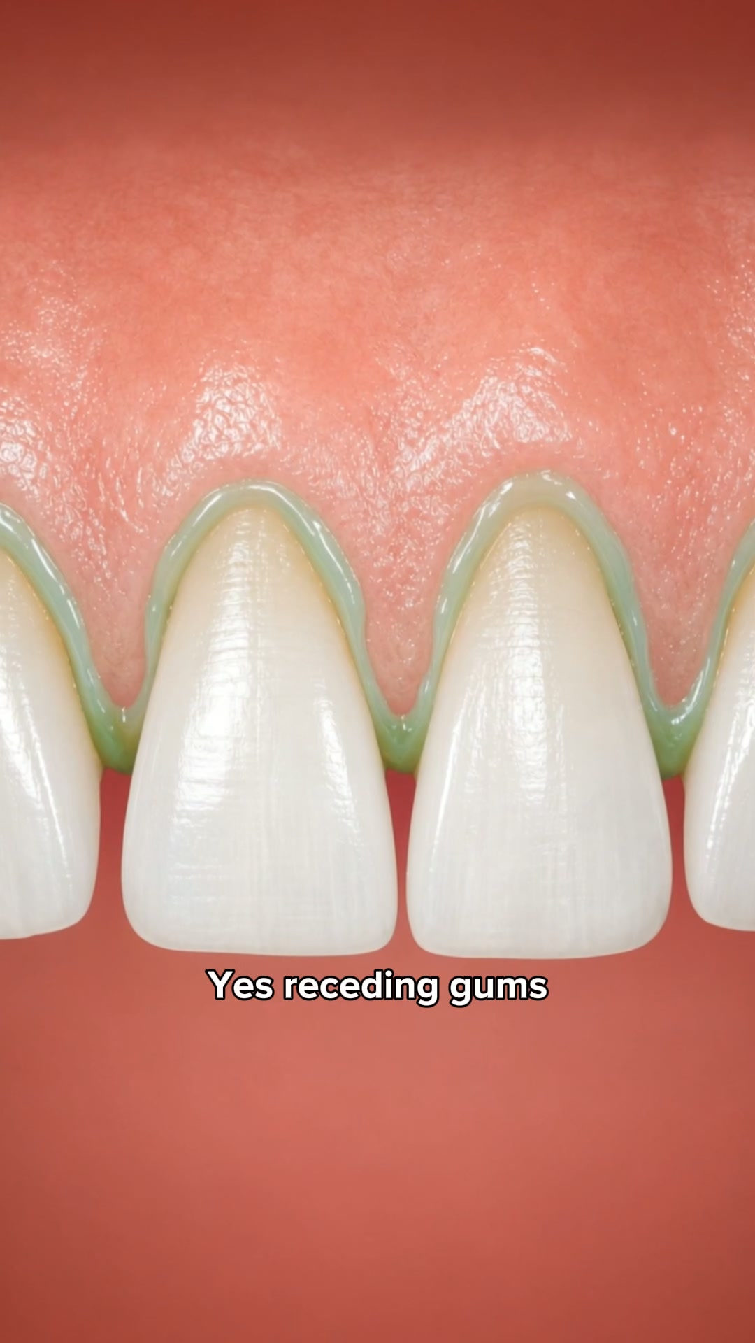 My Gums Kept Pulling Back