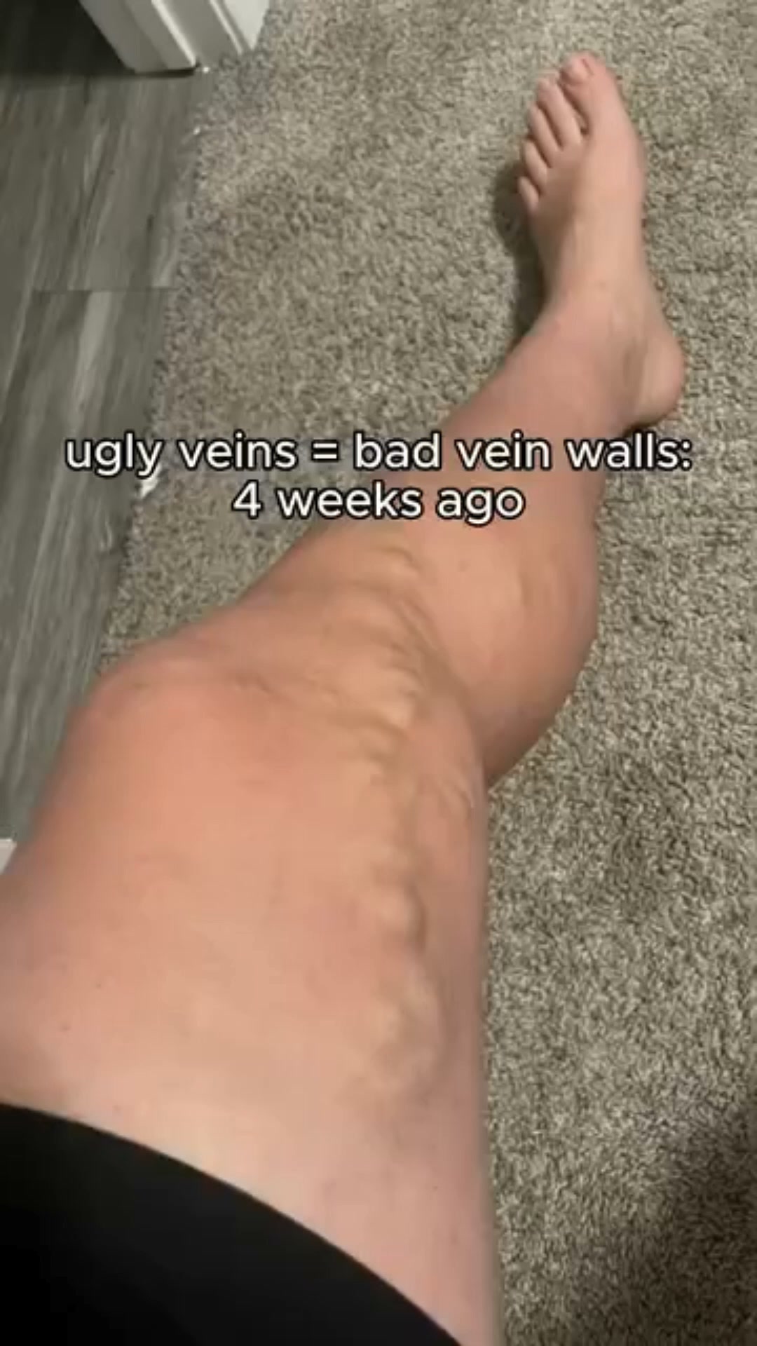 Reduce the Look of Varicose Veins Naturally