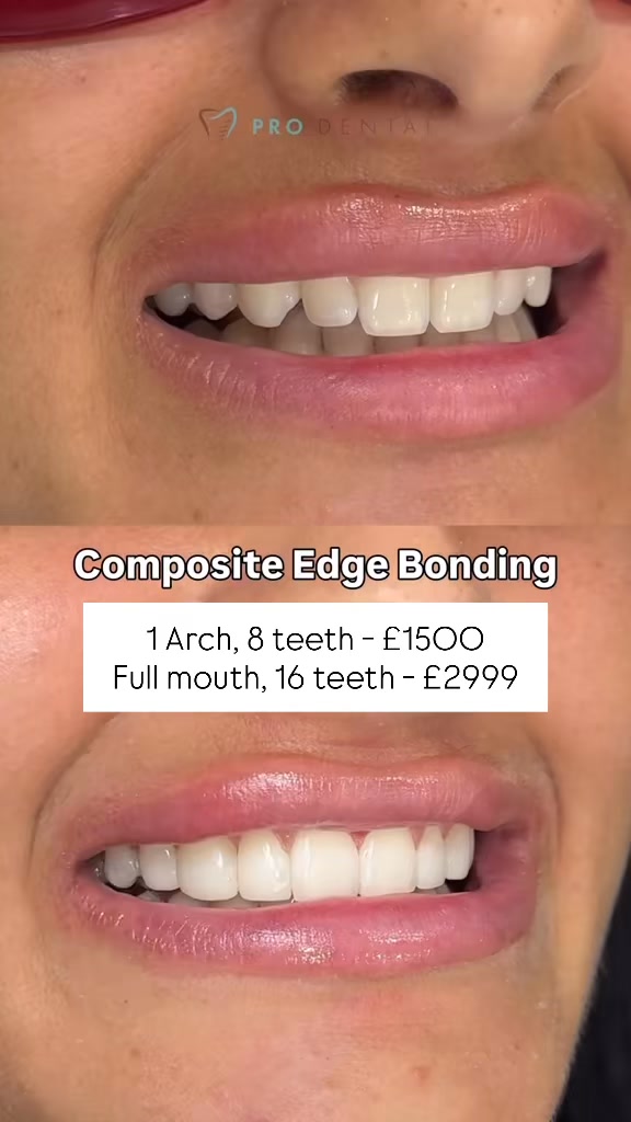 Up to 50% Composite Bonding and Veneers