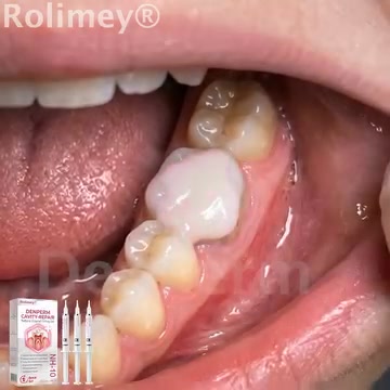 Cavity Repair | FDA-Recognized 10% Nano-Hydroxyapatite (NH-10) | Delivery Within 2–4 Business Days | Full Money-Back Guarantee