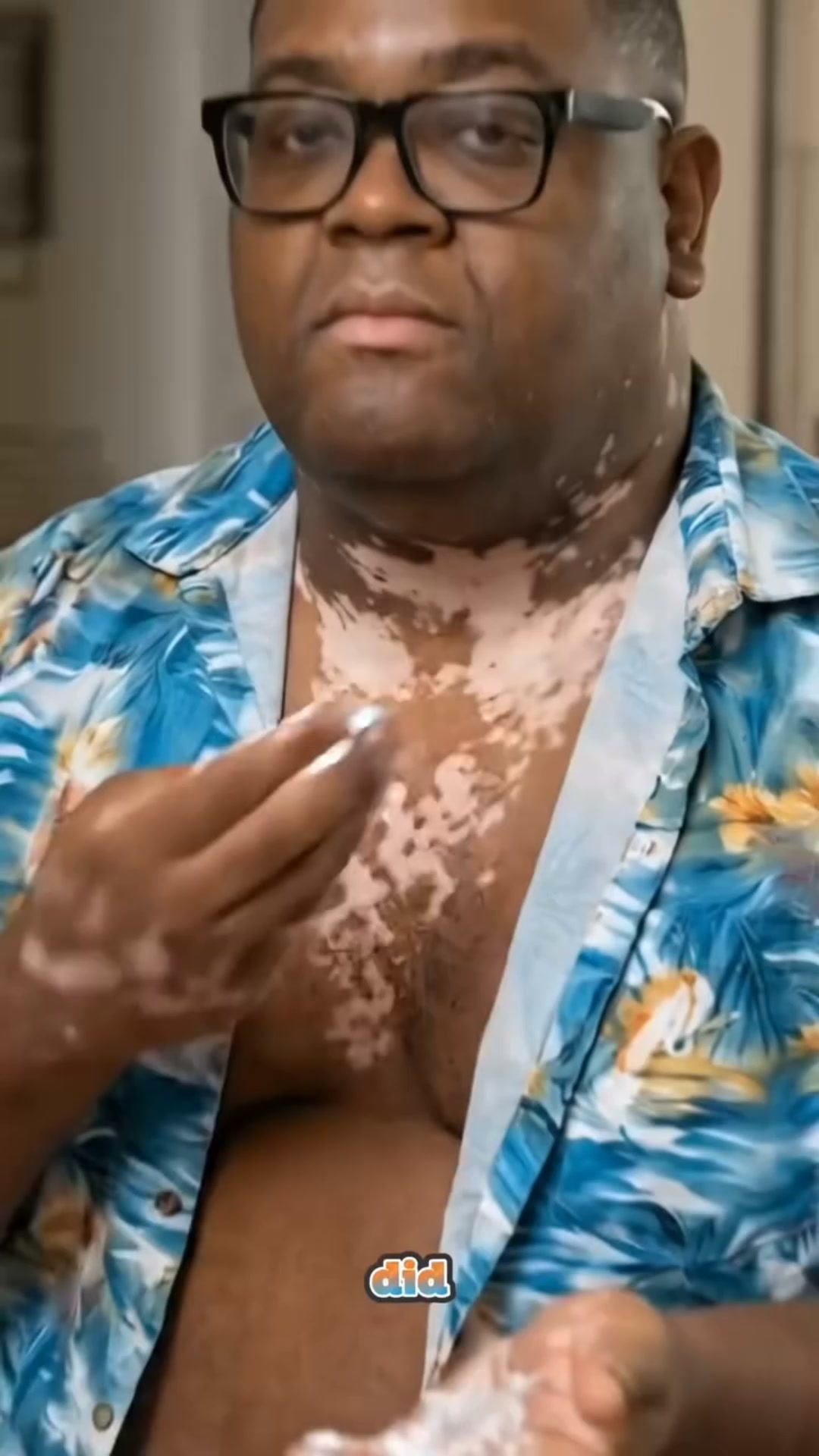 Fast and easy fix for vitiligo.