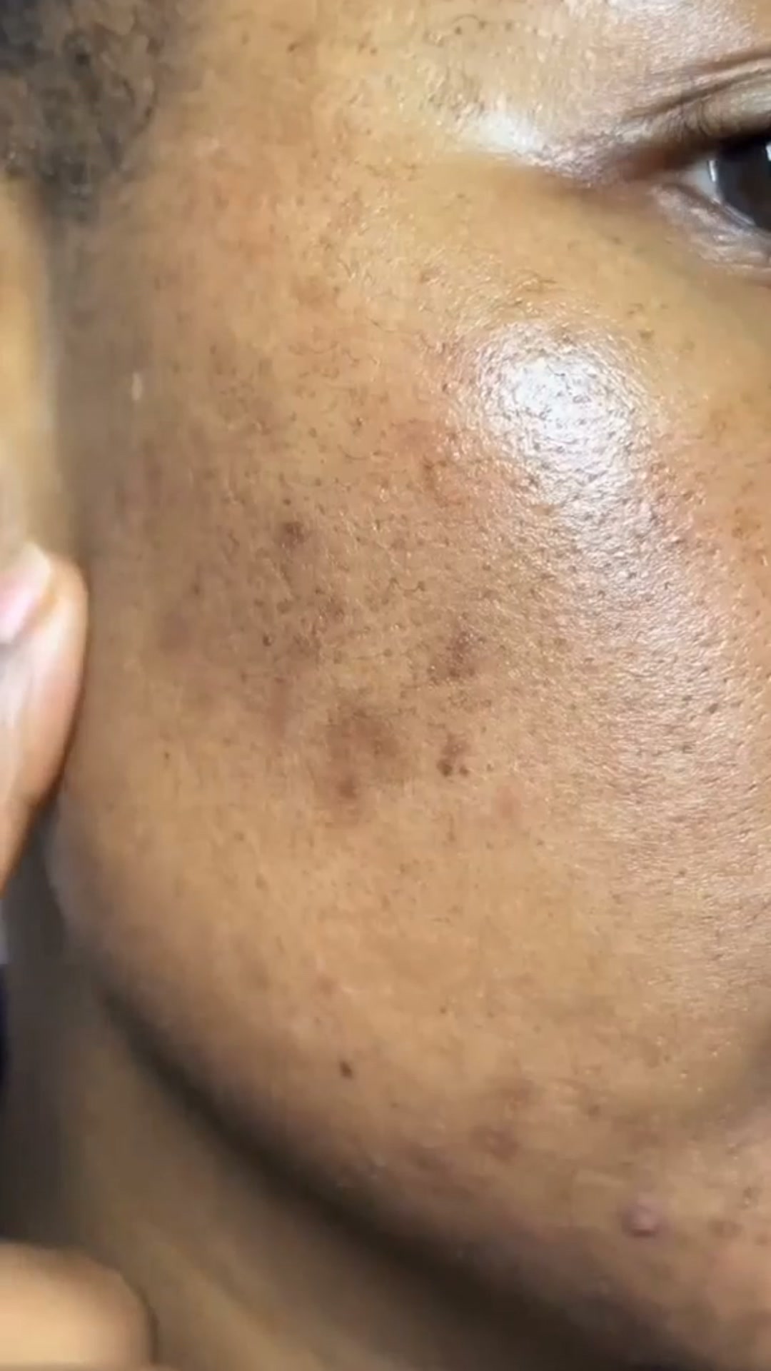 Bright Skin, Simplified