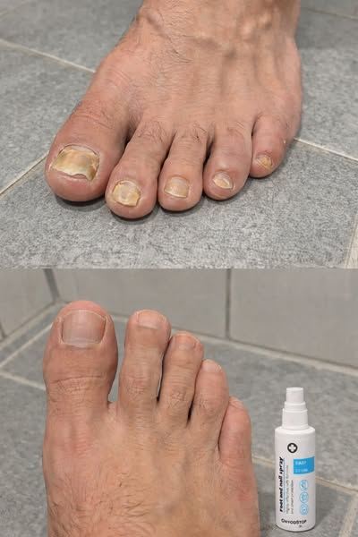 "Eu pensava que nunca me conseguiria livrar da micose!"